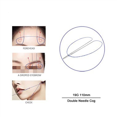 Doppelter Nadelfadenlift